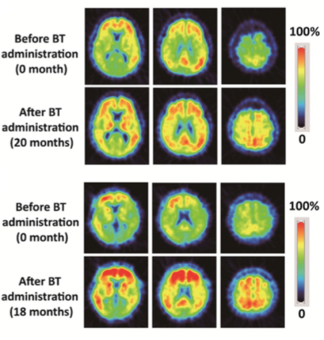 Brain Scans for Vitamin B and Alzheimers Treatment Experiments
