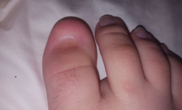 A toe without a nail. What happens if you don't drain a subungual hematoma? In extreme cases the toenail might fall off