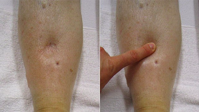 Picture of pitting vs non-pitting edema