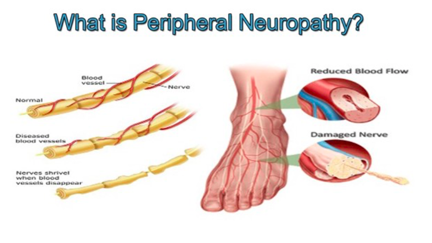 An explanation of what is Peripheral Neuropathy