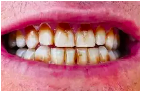 Someone's teeth showing gum disease